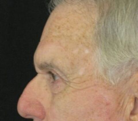 blepharoplasty (eyelid lift): Case 6 - After