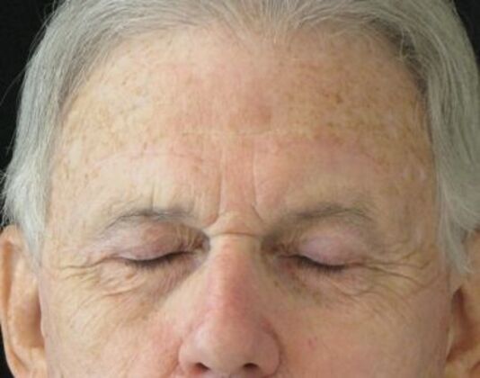blepharoplasty (eyelid lift): Case 6 - After