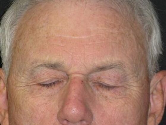 blepharoplasty (eyelid lift): Case 6 - Before
