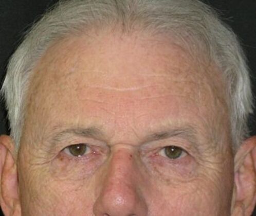 Brow lift: Case 4 - Before