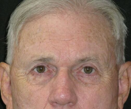 Brow lift: Case 4 - After