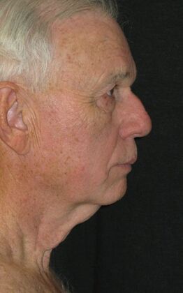 Neck lift  Case 1 - Before