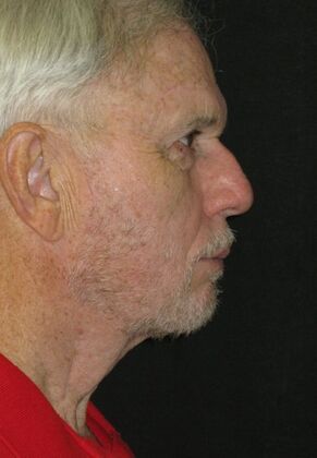 Neck lift  Case 1 - After