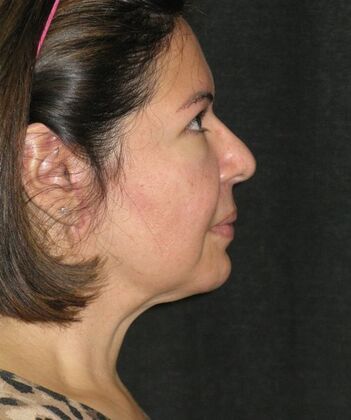 Neck lift  Case 2 - After