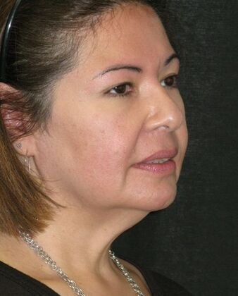 Neck lift : Case 2 - Before