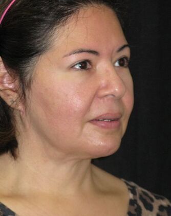 Neck lift : Case 2 - After