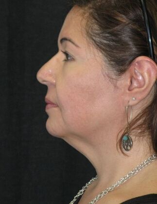 Neck lift : Case 2 - Before