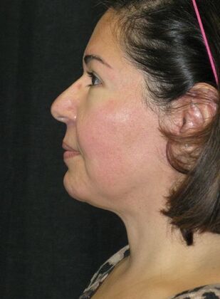 Neck lift : Case 2 - After