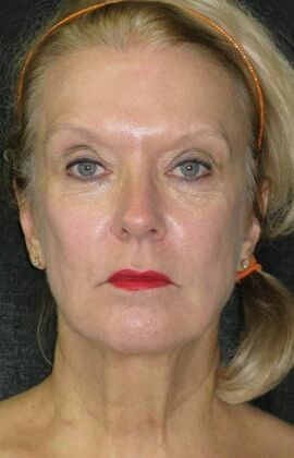 Neck lift  Case 3 - Before