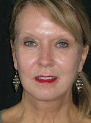 Neck lift  Case 3 - After