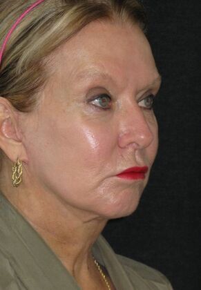 Neck lift : Case 3 - After