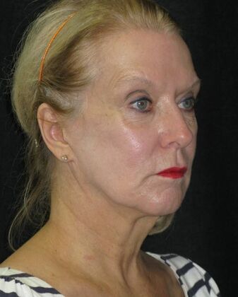 Neck lift : Case 3 - Before