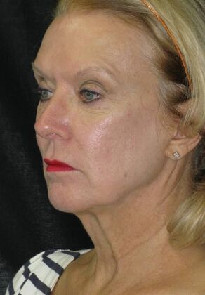 Neck lift : Case 3 - Before