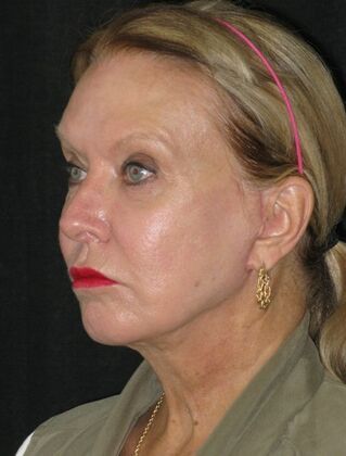 Neck lift : Case 3 - After