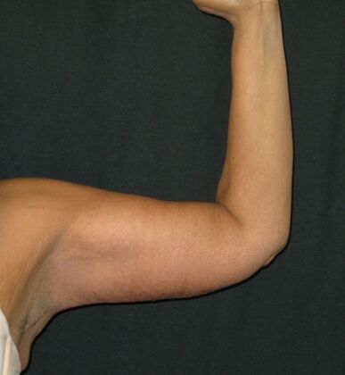 Brachioplasty (Arm Lift): Case 4 - After