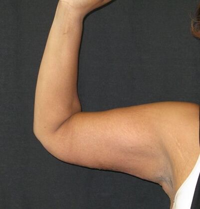 Brachioplasty (Arm Lift) Case 4 - After