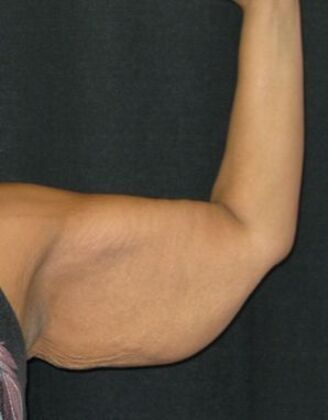 Brachioplasty (Arm Lift): Case 4 - Before