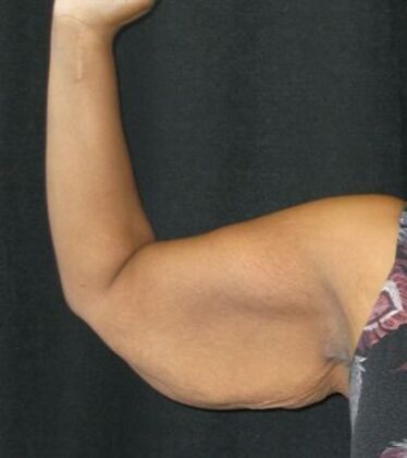 Brachioplasty (Arm Lift) Case 4 - Before