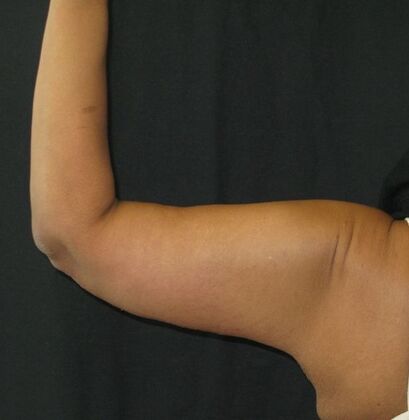Brachioplasty (Arm Lift): Case 4 - After