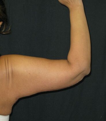Brachioplasty (Arm Lift): Case 4 - After