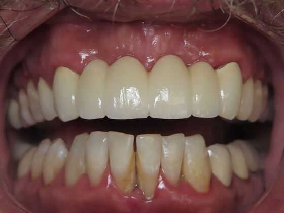 Bridges Case 1 - After