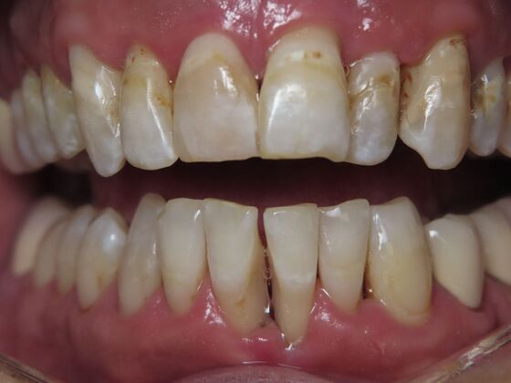 Bridges Case 1 - Before