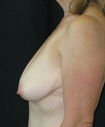 Breast Augmentation: Case 15 - Before