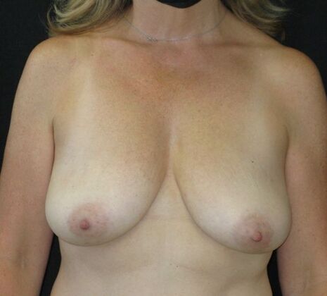 Breast Augmentation Case 15 - Before