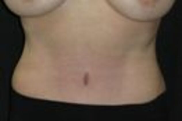 Abdominoplasty Case 10 - After