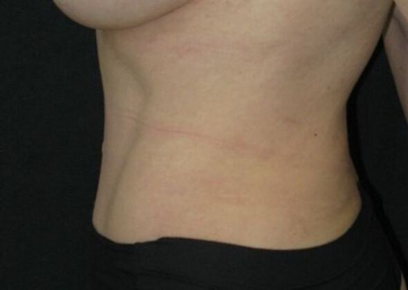 Abdominoplasty: Case 10 - After