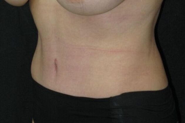 Abdominoplasty: Case 10 - After