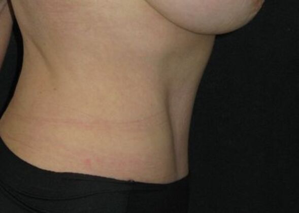 Abdominoplasty: Case 10 - After