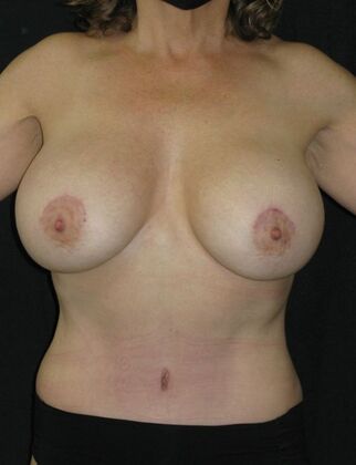 Abdominoplasty: Case 10 - After