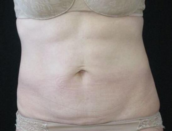 Abdominoplasty Case 10 - Before