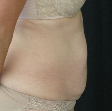 Abdominoplasty: Case 10 - Before