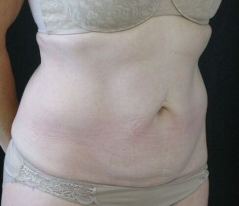 Abdominoplasty: Case 10 - Before