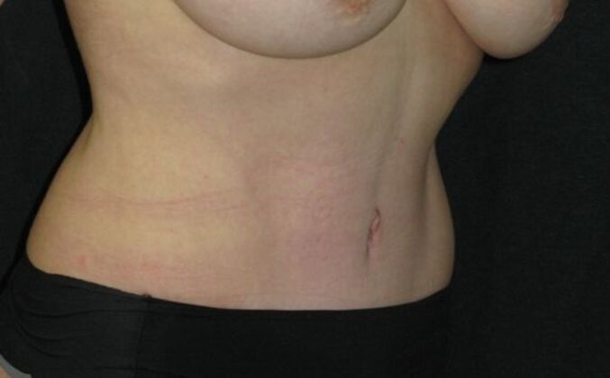 Abdominoplasty: Case 10 - After