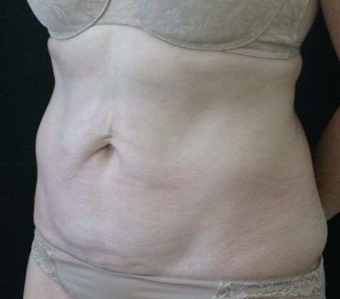 Abdominoplasty: Case 10 - Before