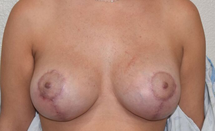 Breast Augmentation w/ Lift Case 503 - After