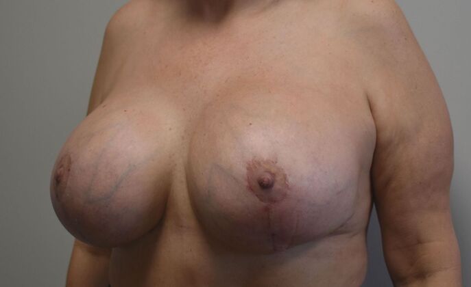 Breast Revision: Case 224 - After
