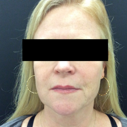 Skin Treatments: Case 5 - Before