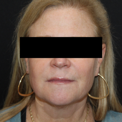 Skin Treatments: Case 5 - After