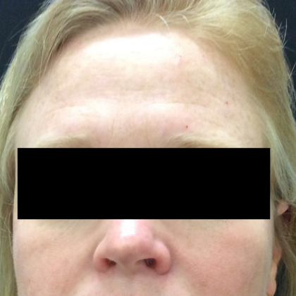 Skin Treatments Case 5 - Before