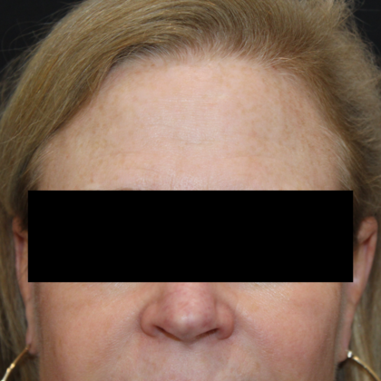 Skin Treatments Case 5 - After