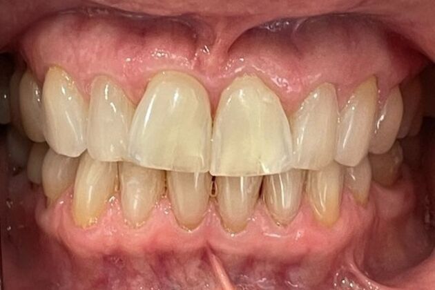 Dental Crowns: Case 1 - Before