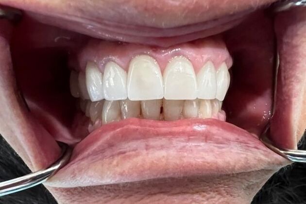 Dental Crowns: Case 1 - After
