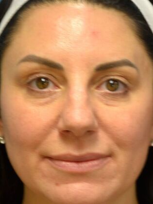 Rhinoplasty Case 1735- Rossford, OH - Before