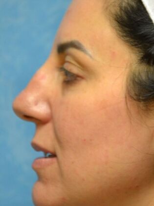 Rhinoplasty: Case 1735- Rossford, OH - Before