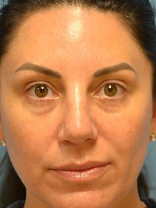 Rhinoplasty Case 1735- Rossford, OH - After