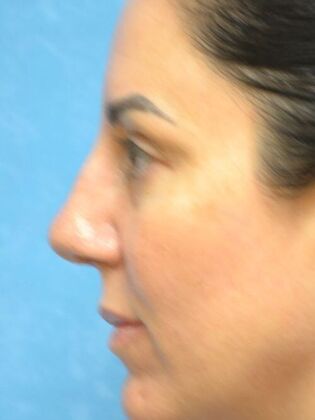 Rhinoplasty: Case 1735- Rossford, OH - After